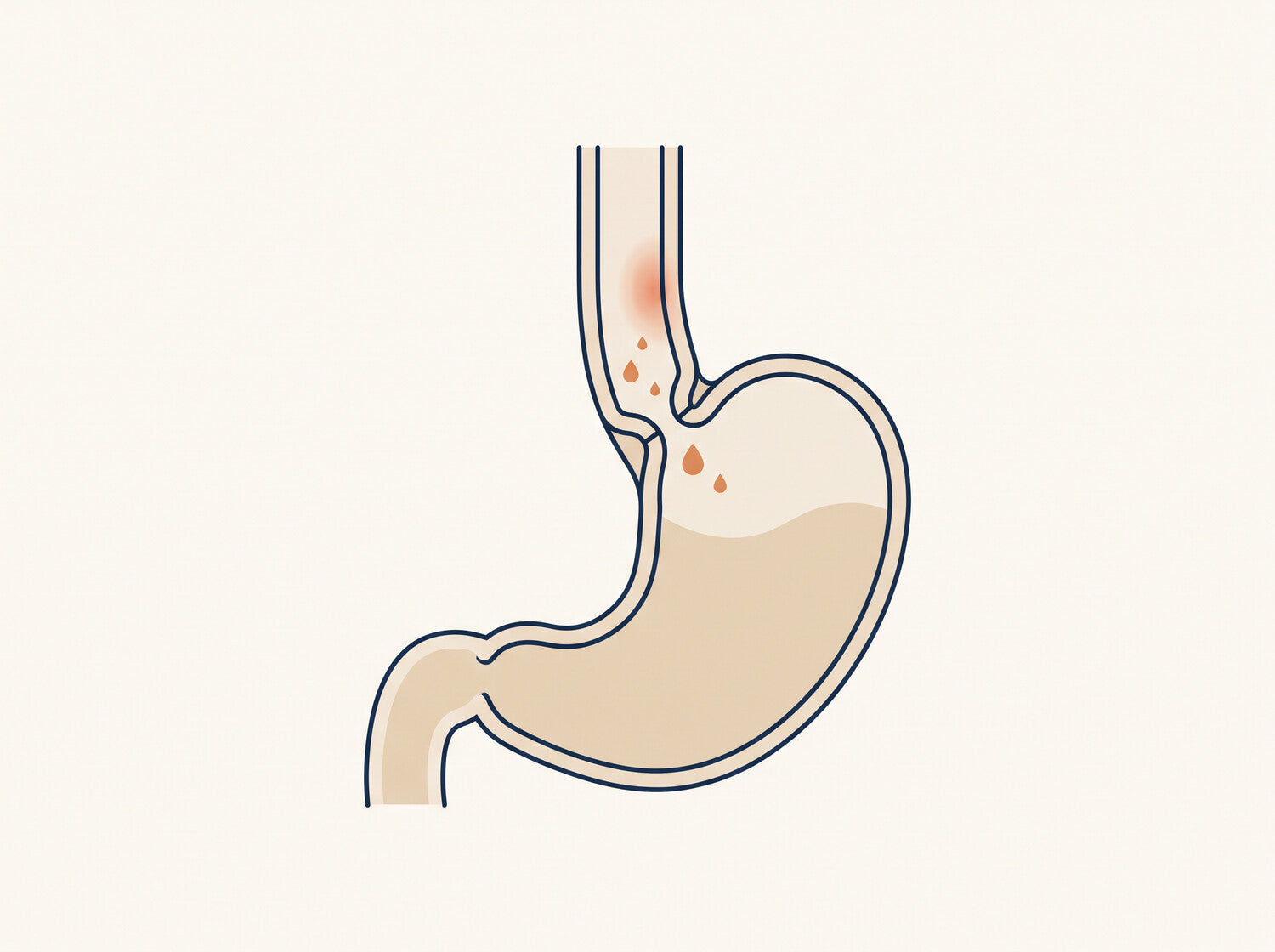 A simple cross-section of the stomach and lower esophagus showing a loose valve, rising droplets and an irritated patch of lining.