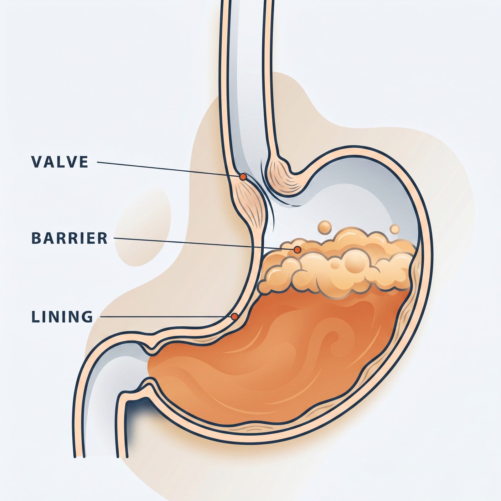 The 3-layer reflux mechanism